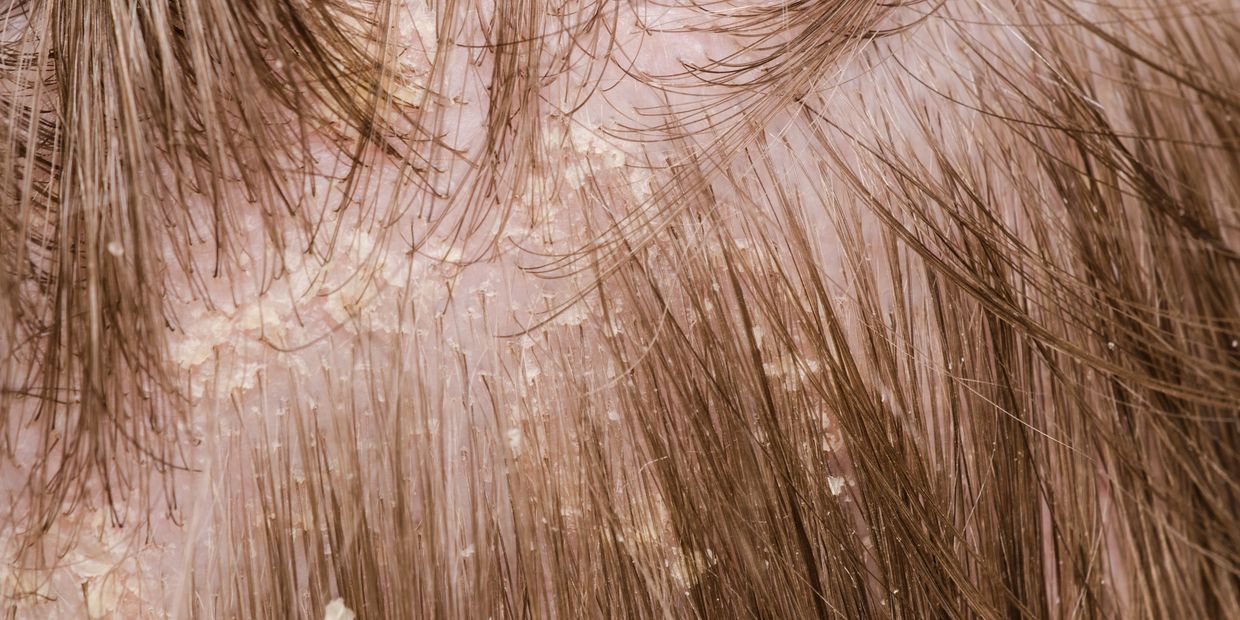 Close-up of scalp with dandruff flakes.