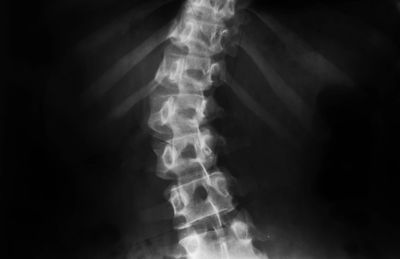 X-Ray of a curved spine, showing scoliosis.