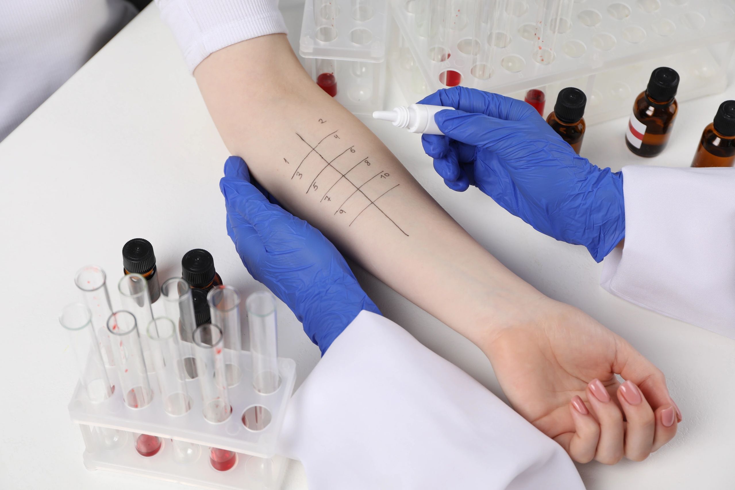 Allergy skin test being performed on an arm.