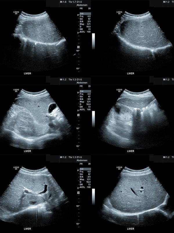 Six ultrasound images showing different views of the liver.