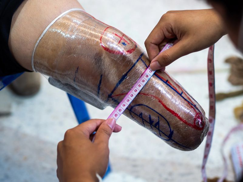 Medical personnel measuring amputated leg to make a prosthetic leg.