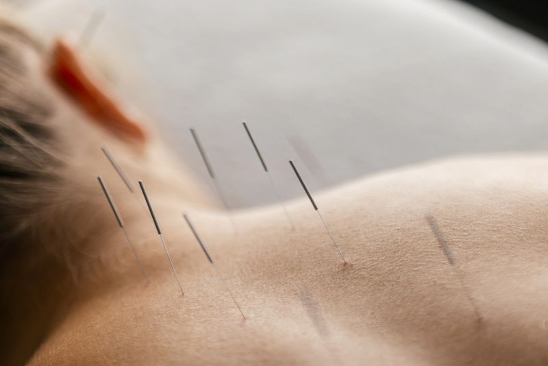 A young woman getting an acupuncture treatment on her back. she is lying face down on the bed.