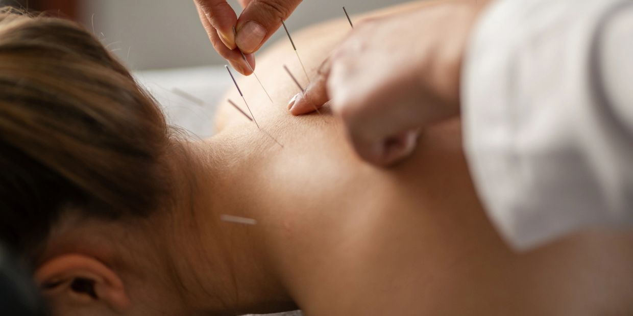 A person receiving acupuncture treatment on their neck and upper back.