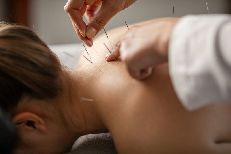 A young woman getting an acupuncture treatment on her back. She is lying face down on the bed.