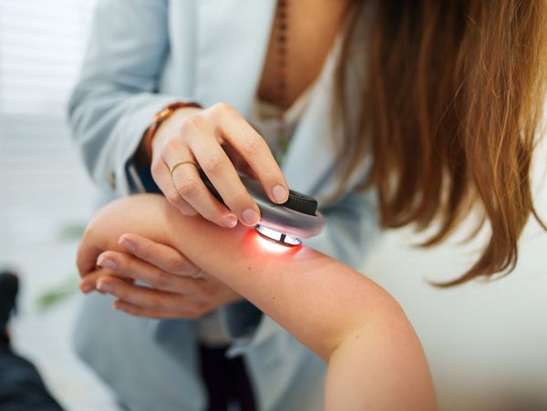 mole checking service, map my mole partner, benign mole treatment flintshire, north Wales, Chester 