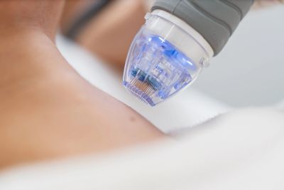 Close-up of microneedling device on shoulder skin for cosmetic treatment.