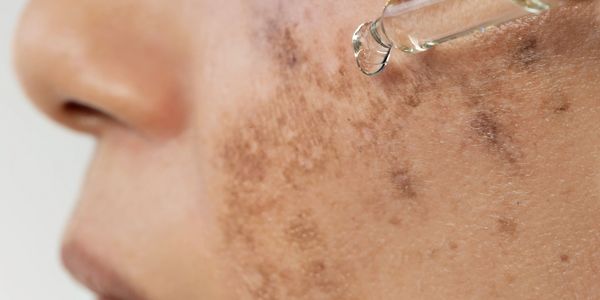 Melasma Treatment