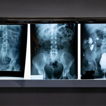 Three pelvic and abdominal X-ray images displayed on a lightbox.