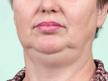 Skin Tightening
Contouring 
Mesotherapy (Fat Reduction/lypolysis)
Kybella 