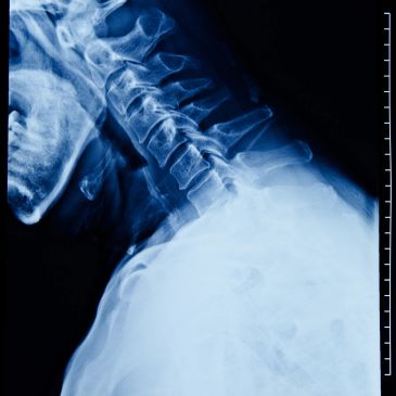 X-ray image of the cervical spine.