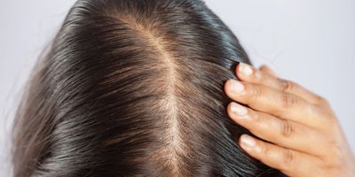 A photo of a ladies scalp after receiving scalp microneedling in cobham Surrey to help with hair los