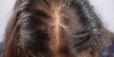 Close-up of a woman’s scalp showing thinning hair and visible scalp.