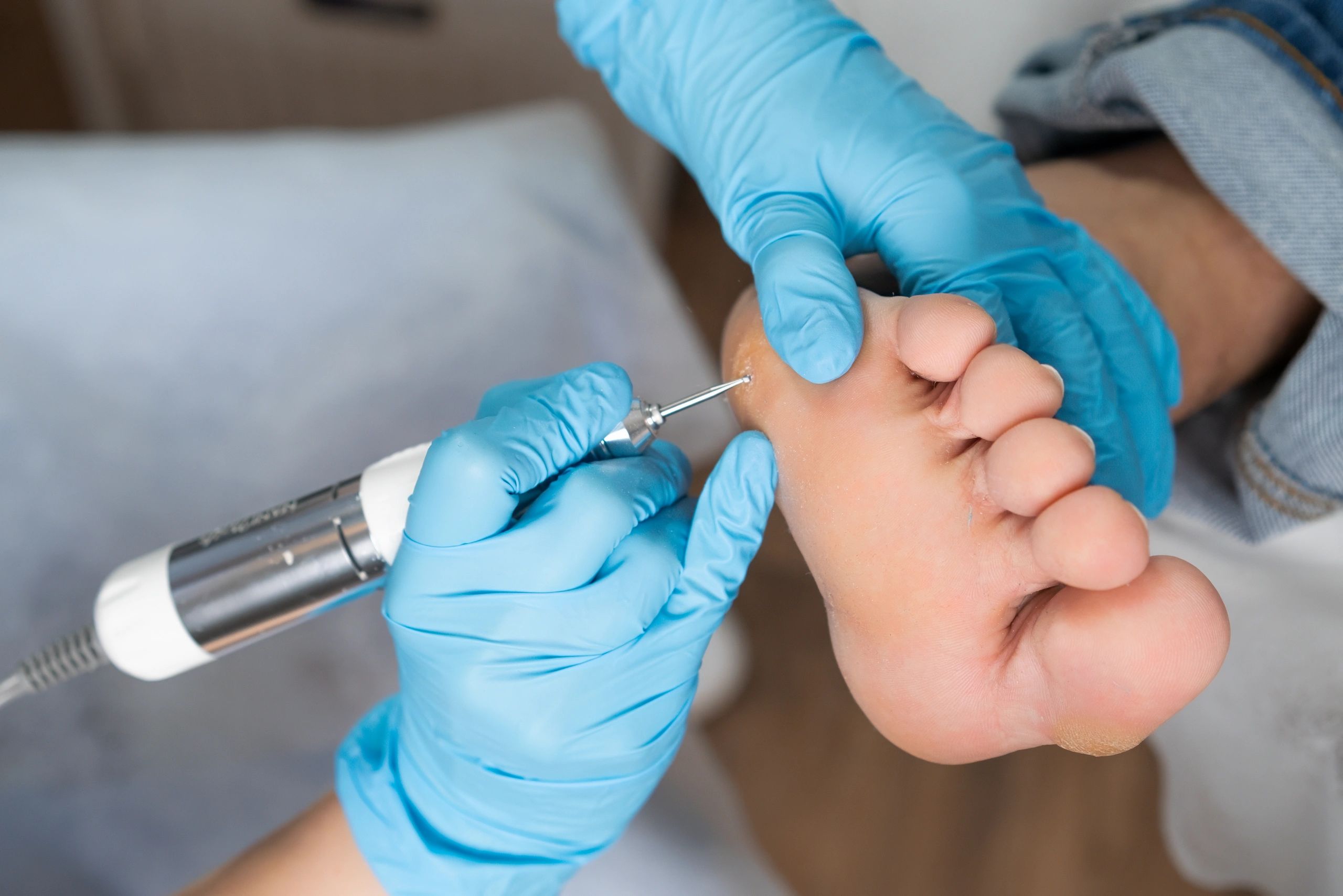 Gloved clinician using a rotary instrument on the sole of a patient’s foot.