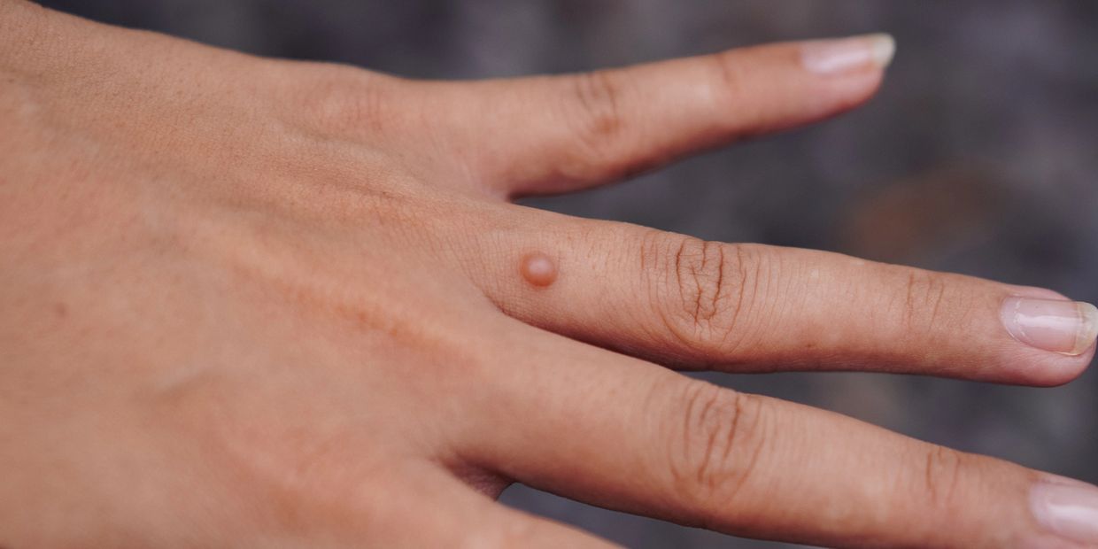 effective wart and verruca treatment  hawarden, Deeside, Chester, wirral