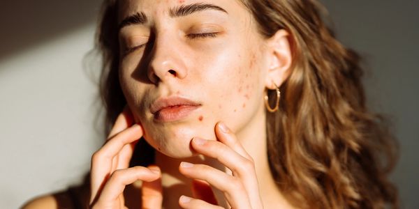 acne, scarring, inflamed 