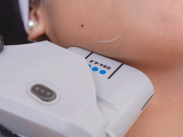 Tratamiento rejuvenecimiento facial con HIFU en Castelldefels