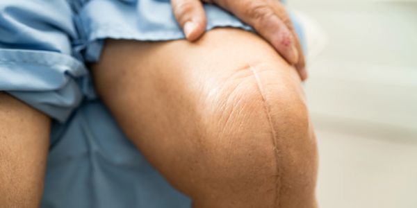 Total knee replacement scar
