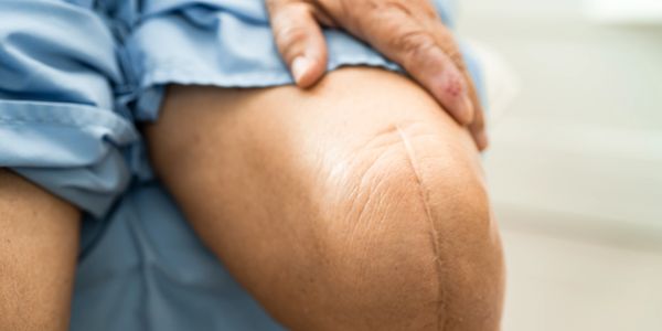 Total knee replacement scar
