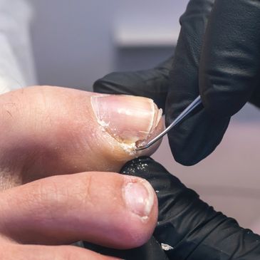 Ingrown Nails Treatments