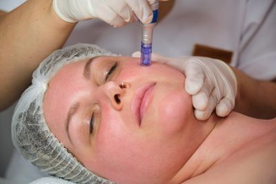 A young lady is getting microneedling treatment .