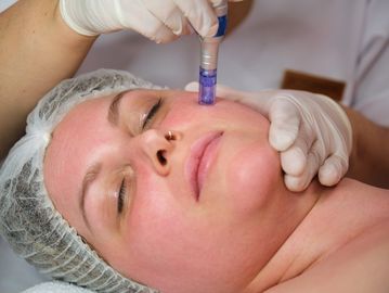 Microdermabrasion treatment on a woman's face.