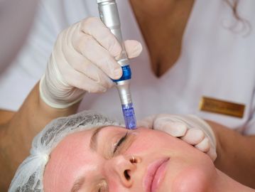 Microneedling for facial wrinkles and collagen rejuvenating