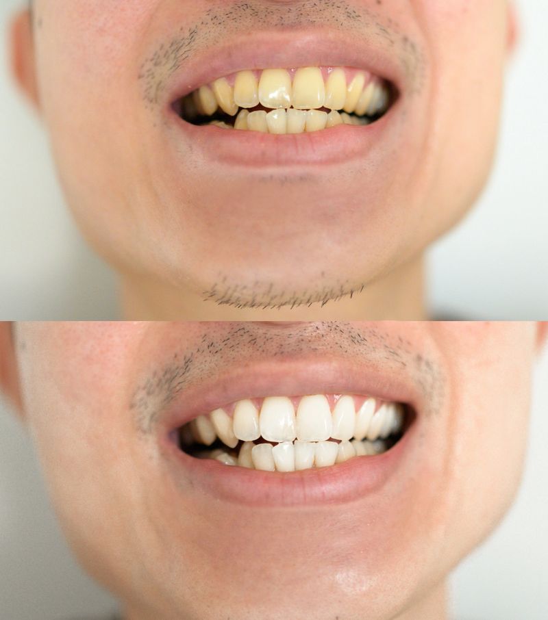 Close-up men teeth Before / after cleaning with Teeth whitening or Tooth bleaching with dentist clinic technic