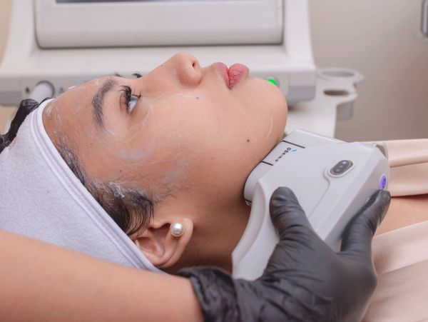 Tratamiento de Rejuvenecimiento facial con HIFU en Castelldefels