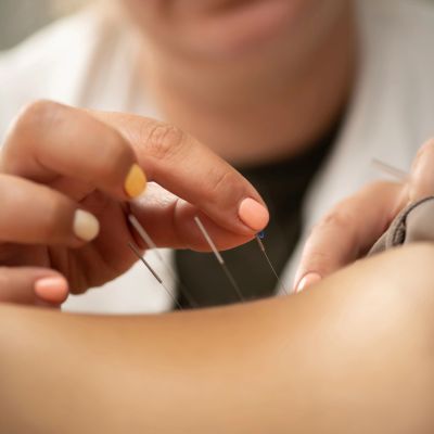 Close-up of hands performing acupuncture treatment.