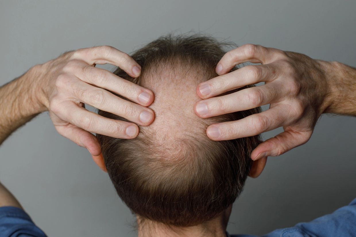 stem cell therapy to treat hair loss and stimulate hair regrowth for thicker, healthier hair