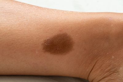 Close-up of a brown birthmark on a person's ankle.