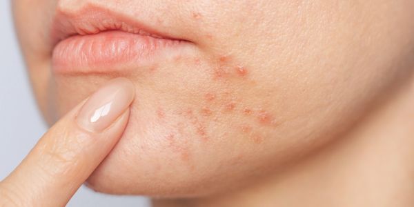 Dermatologist for acne treatment