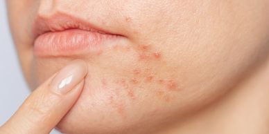 Acne Treatment Columbus GA