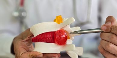 Model of a spinal disc herniation held by a doctor.