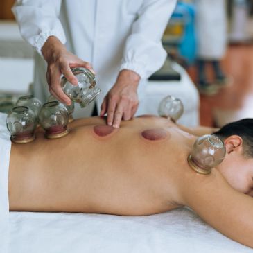 Person receiving cupping therapy on their back.
