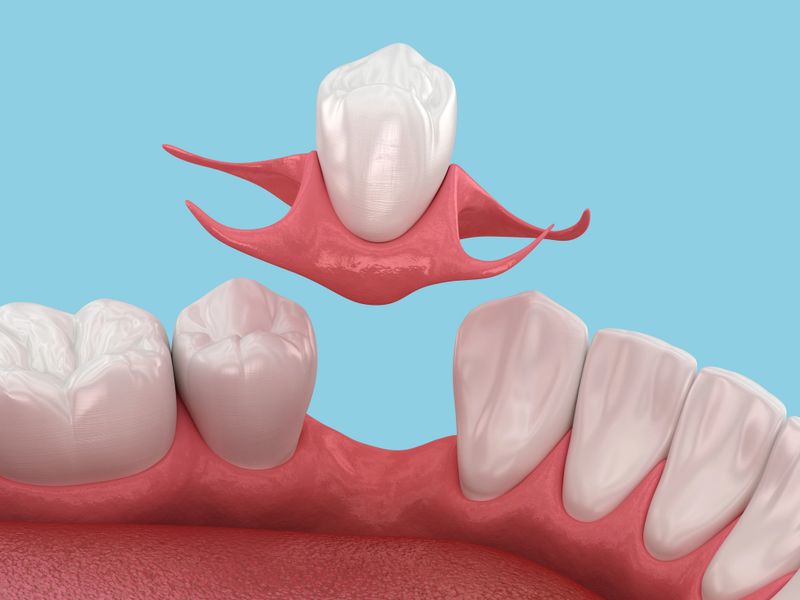 Bridges and replacement of missing teeth