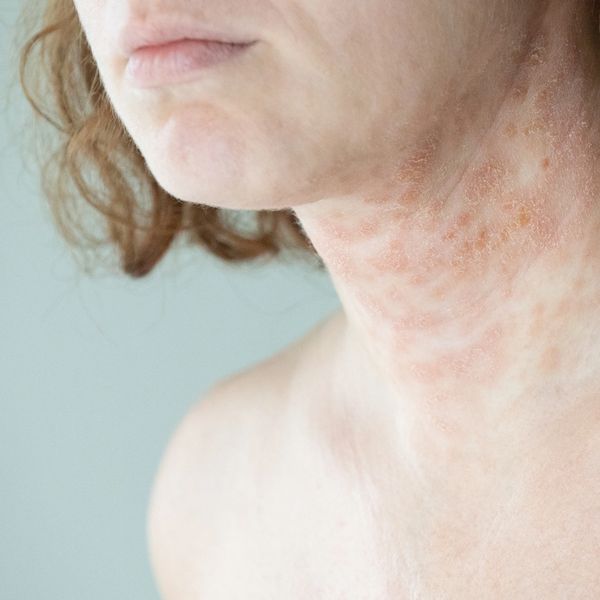 Skin rash on a woman's neck.