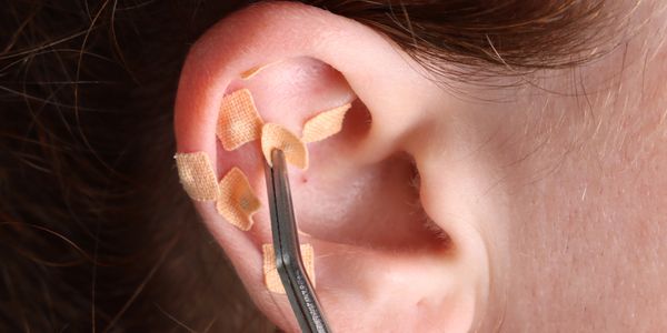 Ear with multiple small adhesive bandages applied carefully.
