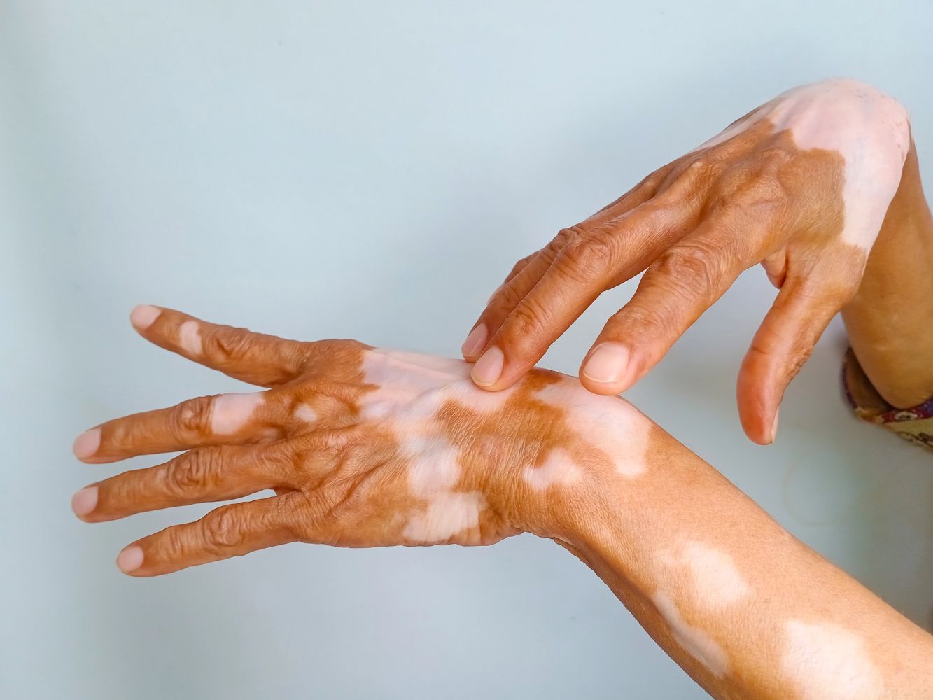 Vitiligo vulgaris