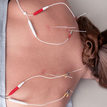 Electroacupuncture needles with wires on a person's back.