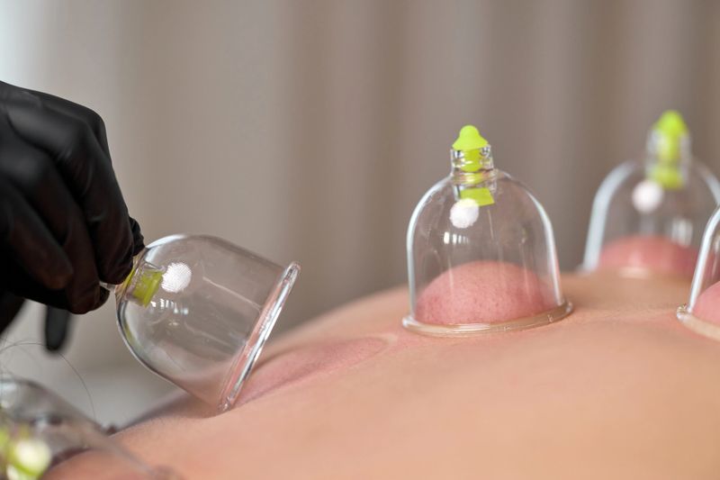 Close-up of suction cups placed on a patient's stomach during cupping therapy