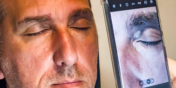 Before and after treatment for yellow cholesterol deposits on eyelids
