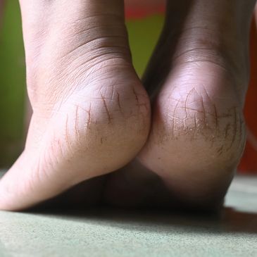 Cracked Heel Treatments