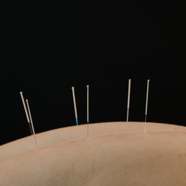 Six acupuncture needles inserted into skin.