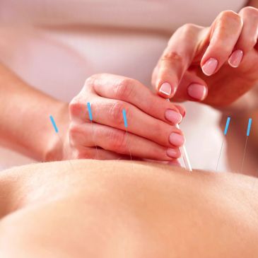 Acupuncture treatment with needles on a person's back.
