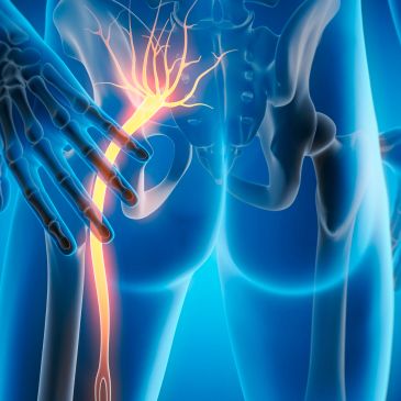 Illustration of sciatic nerve pain in the lower back and leg.