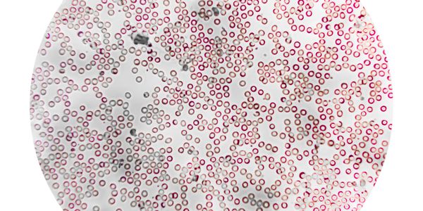Microscopic view of red blood cells stained for analysis.
