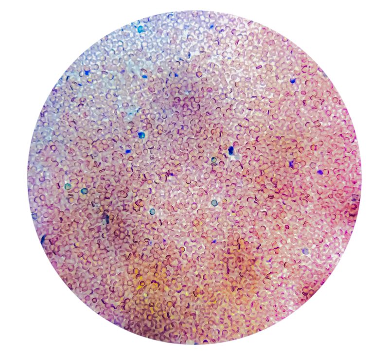 Photomicrograph of  Abnormal red blood cells from thalassemia patient.