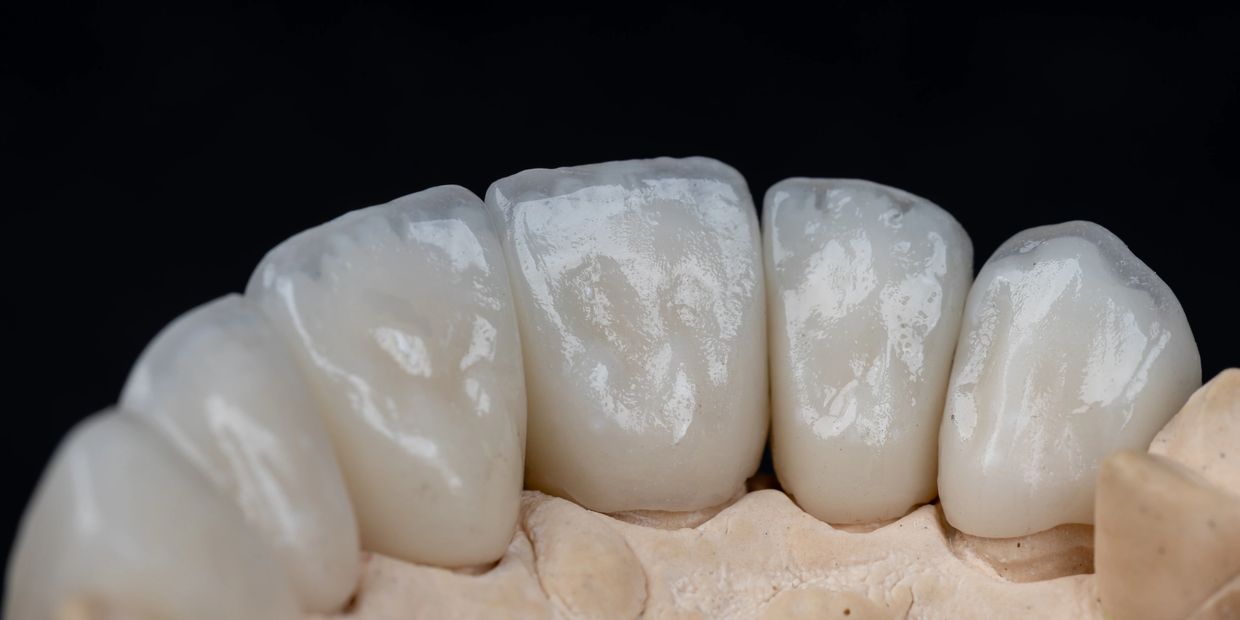 Close-up of dental crowns on a plaster model against a black background.