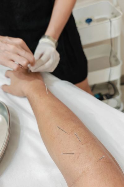 Acupuncture needles in a person's arm and hand.